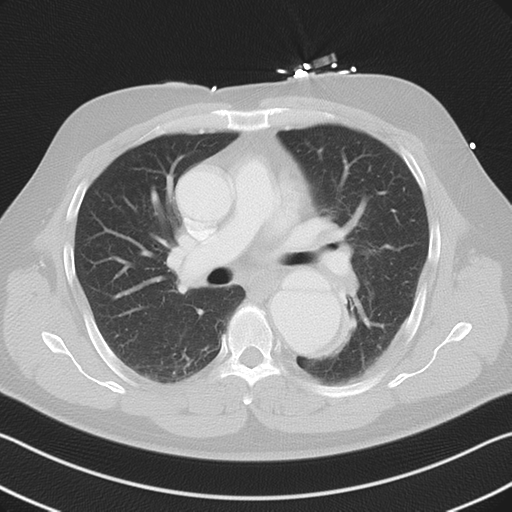 File:Aortic dissection (Radiopaedia 50763-56234 Axial lung window 32).png