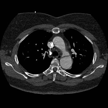 Aortic dissection (Radiopaedia 57969-64959 A 114).jpg