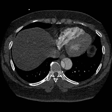 File:Aortic dissection (Radiopaedia 57969-64959 A 229).jpg