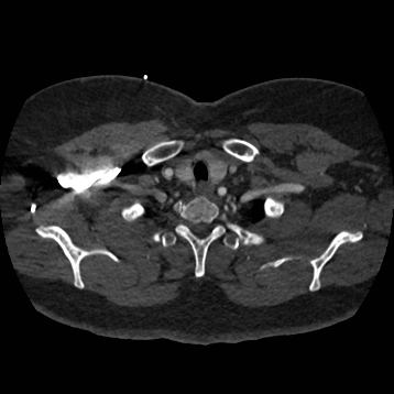 Aortic dissection (Radiopaedia 57969-64959 A 36).jpg