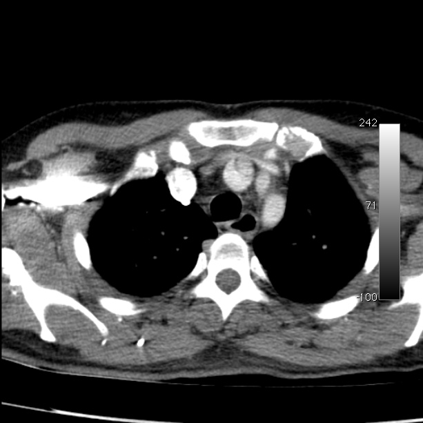 Aortic dissection - Stanford type A (Radiopaedia 29247-29659 A 16).jpg