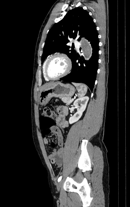 Aortic dissection - Stanford type A (Radiopaedia 83418-98500 B 69).jpg