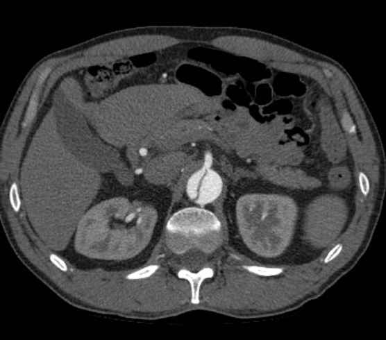 File:Aortic dissection - Stanford type B (Radiopaedia 73648-84437 A 132).jpg