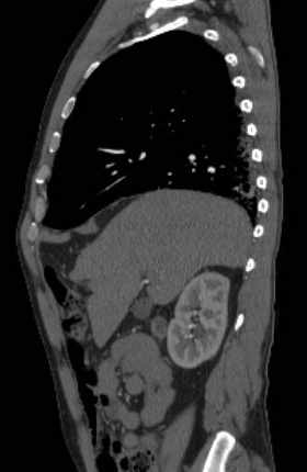 File:Aortic dissection - Stanford type B (Radiopaedia 73648-84437 C 112).jpg
