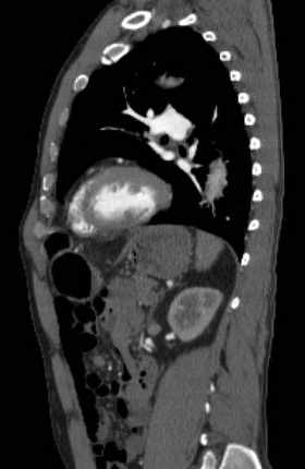 File:Aortic dissection - Stanford type B (Radiopaedia 73648-84437 C 52).jpg