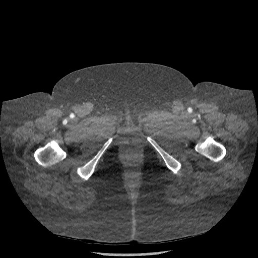 Aortic dissection - Stanford type B (Radiopaedia 88281-104910 A 168).jpg
