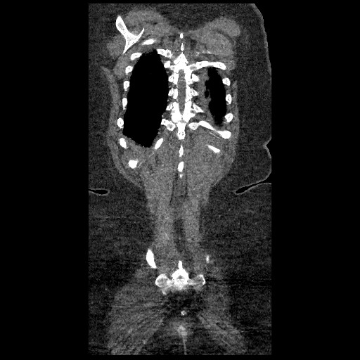 File:Aortic dissection - Stanford type B (Radiopaedia 88281-104910 B 82).jpg