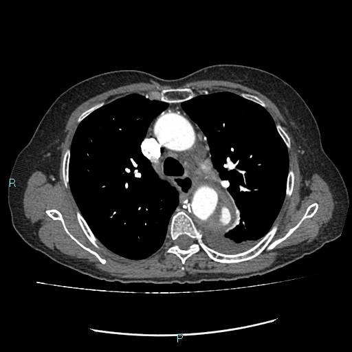 File:Aortic dissection extended to lusory artery (Radiopaedia 43686-47136 B 5).jpg