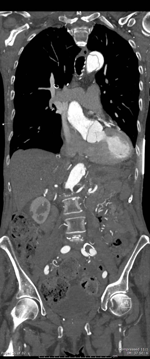 Aortic dissection with extension into aortic arch branches (Radiopaedia 64402-73204 A 36).jpg