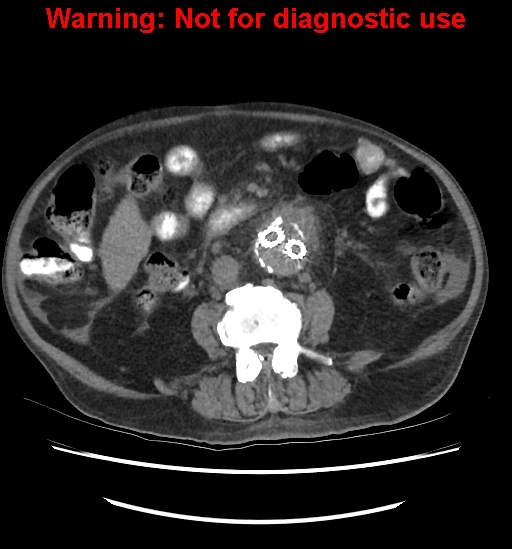 Aortic graft infection (Radiopaedia 44979-48907 Axial non-contrast 54).jpg