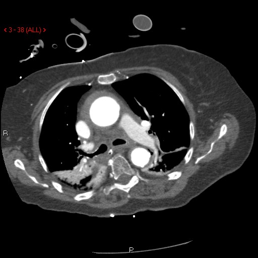 Aortic intramural hematoma (Radiopaedia 27746-28001 A 38).jpg