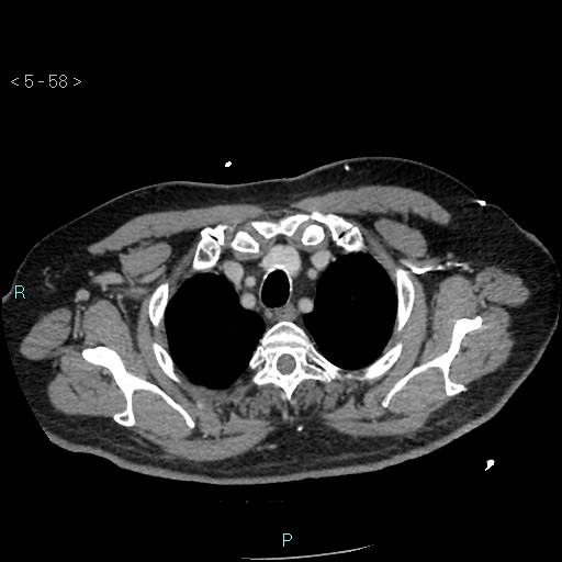 Aortic intramural hematoma (Radiopaedia 48463-53380 C 28).jpg