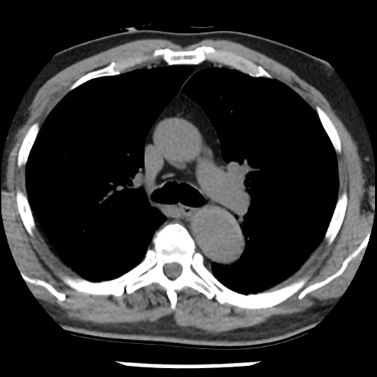 Aortic intramural hematoma (type B) (Radiopaedia 79323-92387 Axial non-contrast 19).jpg