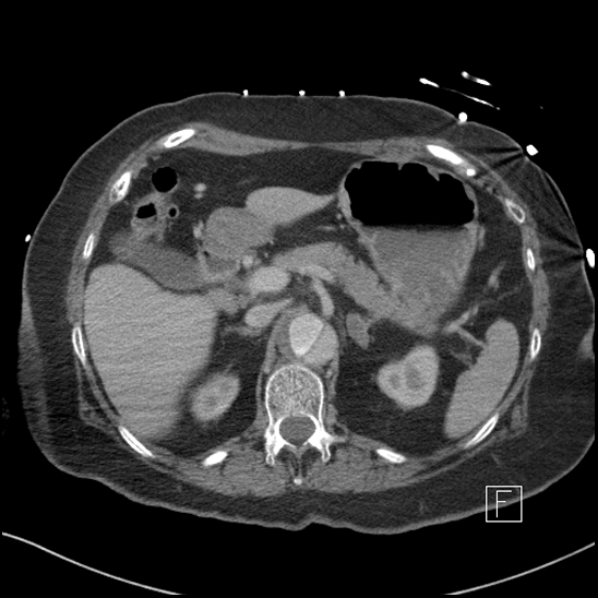 File:Aortic intramural hematoma with dissection and intramural blood pool (Radiopaedia 77373-89491 E 14).jpg