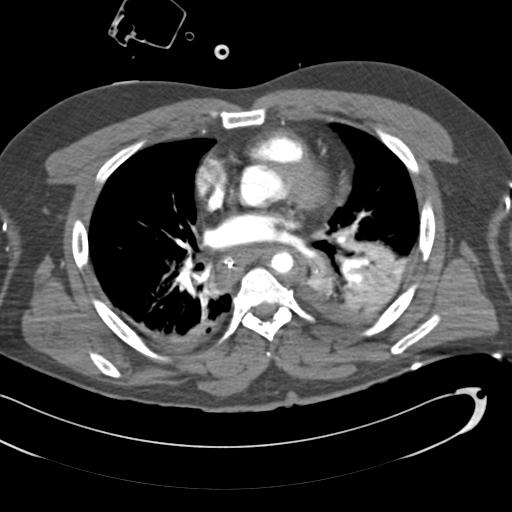 Aortic transection, diaphragmatic rupture and hemoperitoneum in a complex multitrauma patient (Radiopaedia 31701-32622 A 47).jpg