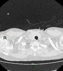 File:Aortic valve endocarditis (Radiopaedia 87209-103485 Axial lung window 11).jpg