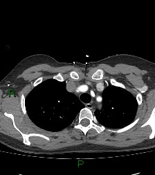 Aortic valve endocarditis (Radiopaedia 87209-103485 C 19).jpg