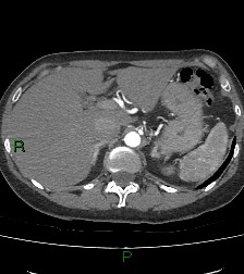 Aortic valve endocarditis (Radiopaedia 87209-103485 C 96).jpg