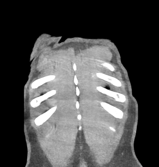 File:Aortic valve non-coronary cusp thrombus (Radiopaedia 55661-62189 C 76).png