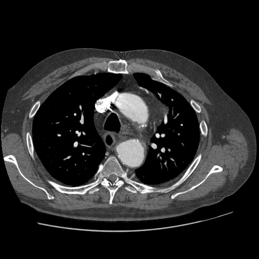 File:Aorto-coronary bypass graft aneurysms (Radiopaedia 40562-43157 A 35).png