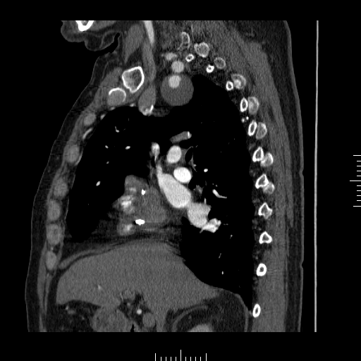 File:Aorto-coronary bypass graft aneurysms (Radiopaedia 40562-43157 C 10).png