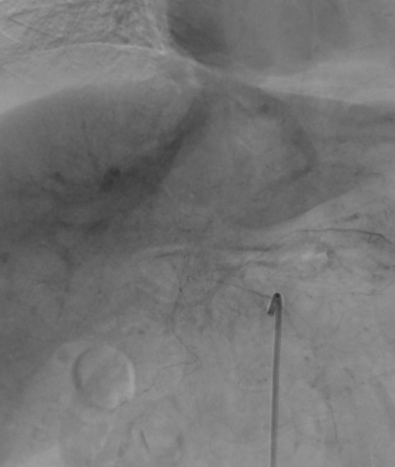 Aorto portal shunt (Radiopaedia 69573-79586 Frontal Celiac axis 59).jpg