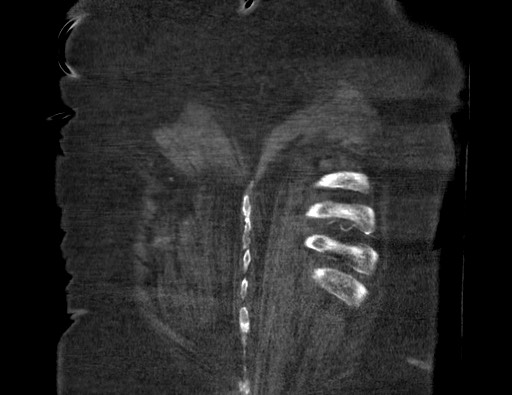Aortoesophageal fistula with endovascular repair (Radiopaedia 73781-84592 Coronal C+ CTPA 133).jpg