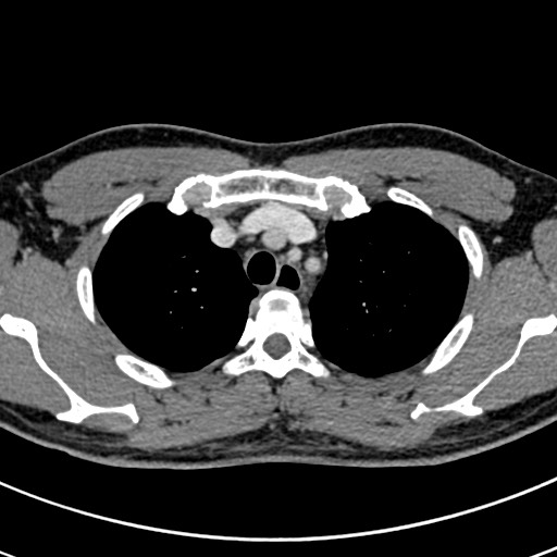 Apical lung mass mimic - neurogenic tumor (Radiopaedia 59918-67521 A 18).jpg