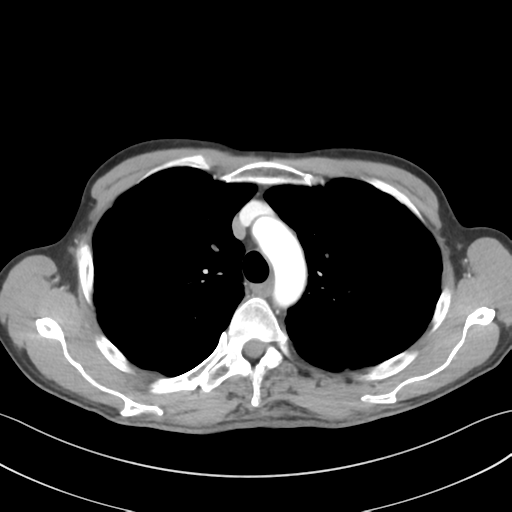 Apical pleural calcification (Radiopaedia 46141-50499 Axial C+ delayed 20).png