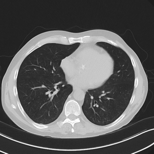 Apical pulmonary metastasis (Radiopaedia 46338-50754 Axial non-contrast 41).png