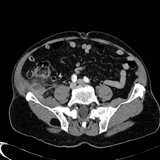 Appendiceal adenocarcinoma complicated by retroperitoneal abscess (Radiopaedia 58007-65039 B 94).jpg