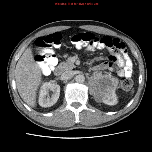 File:Appendicitis and renal cell carcinoma (Radiopaedia 17063-16760 A 19).jpg