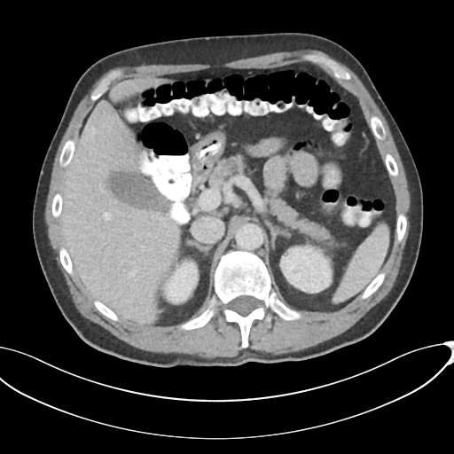 Appendicitis with thickening of the terminal ileum (Radiopaedia 42432-45550 A 29).png