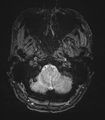 Arachnoid cyst with subdural hematoma (Radiopaedia 85892-101743 Axial SWI 5).png