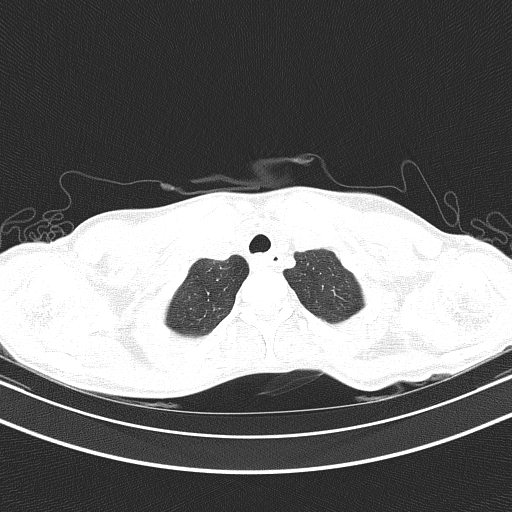 Arteria lusoria (Radiopaedia 88528-105192 Axial lung window 11).jpg
