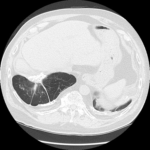 Asbestos-related pleural disease (Radiopaedia 74366-85250 Axial lung window 98).jpg