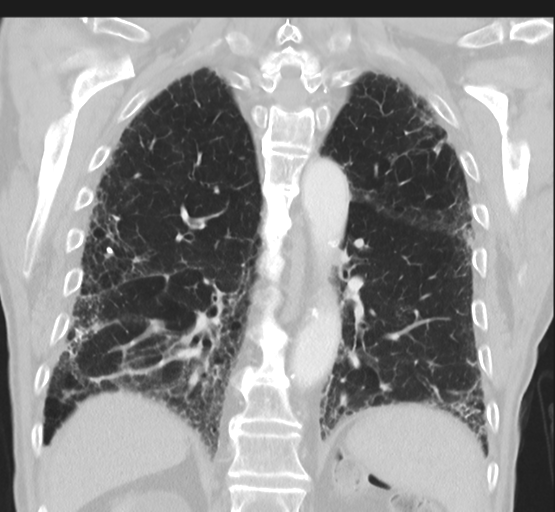Asbestosis (Radiopaedia 56192-62864 Coronal lung window 36).png