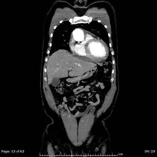 Ascending aortic aneurysm (Radiopaedia 50086-55404 B 13).jpg