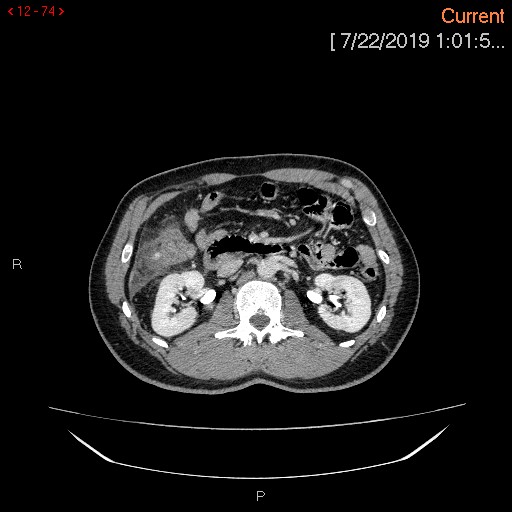 File:Ascending colonic diverticulum mimicking acute appendicitis (Radiopaedia 69943-80198 A 74).jpg