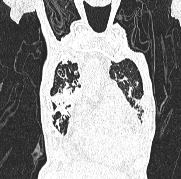Aspergilloma- with Monod sign (Radiopaedia 44737-48532 Coronal lung window 143).jpg
