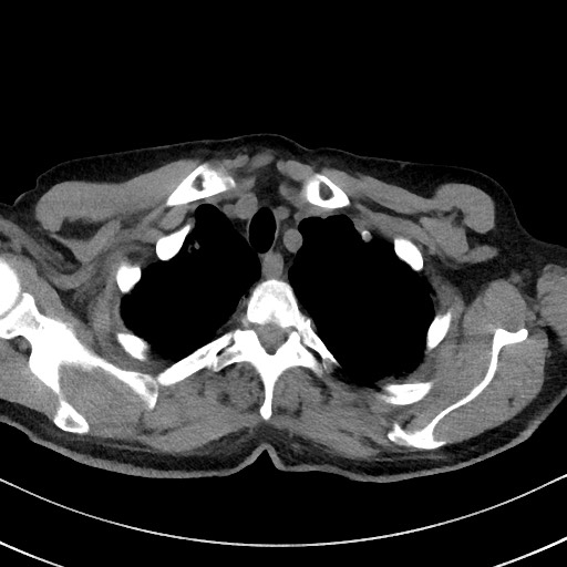 File:Aspergilloma on background pulmonary fibrosis (Radiopaedia 60942-68757 Axial non-contrast 11).jpg