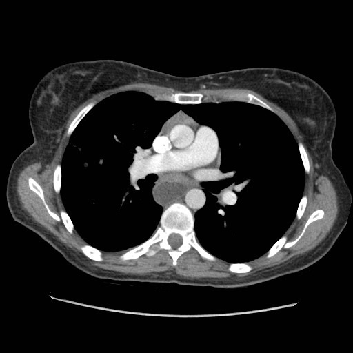 File:Aspiration pneumonia secondary to laparoscopic banding (Radiopaedia 18345-18183 A 23).jpg