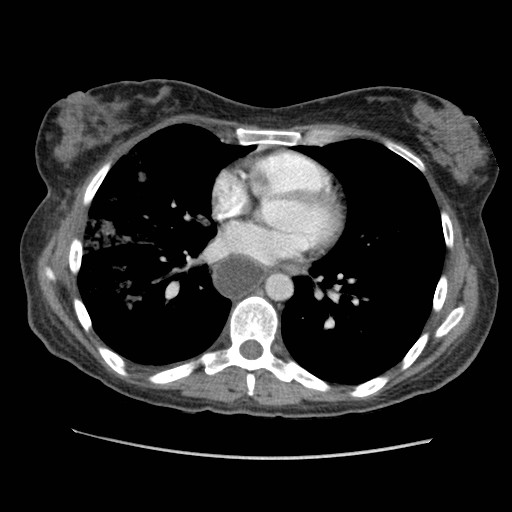Aspiration pneumonia secondary to laparoscopic banding (Radiopaedia 18345-18183 A 30).jpg