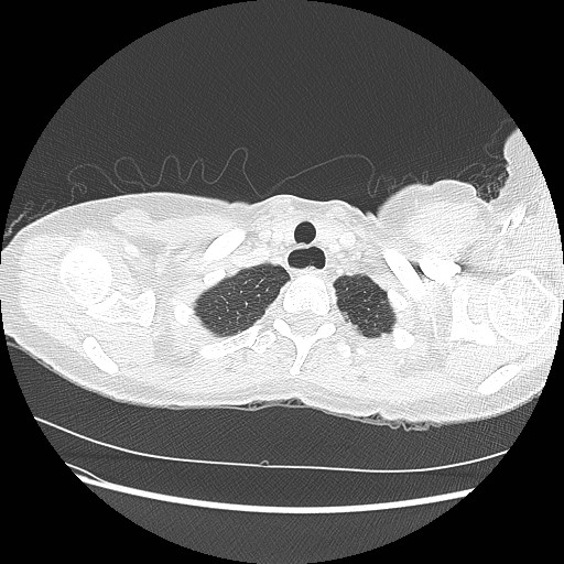 Aspiration pneumonia secondary to laparoscopic banding (Radiopaedia 18345-18183 lung window 4).jpg