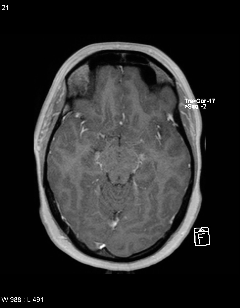 Astroblastoma (Radiopaedia 39792-42217 Axial T1 C+ 20).jpg