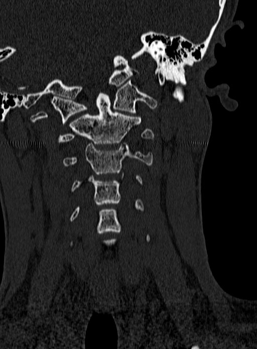 Atlantoaxial subluxation (Radiopaedia 44681-48450 Coronal bone window 35).jpg