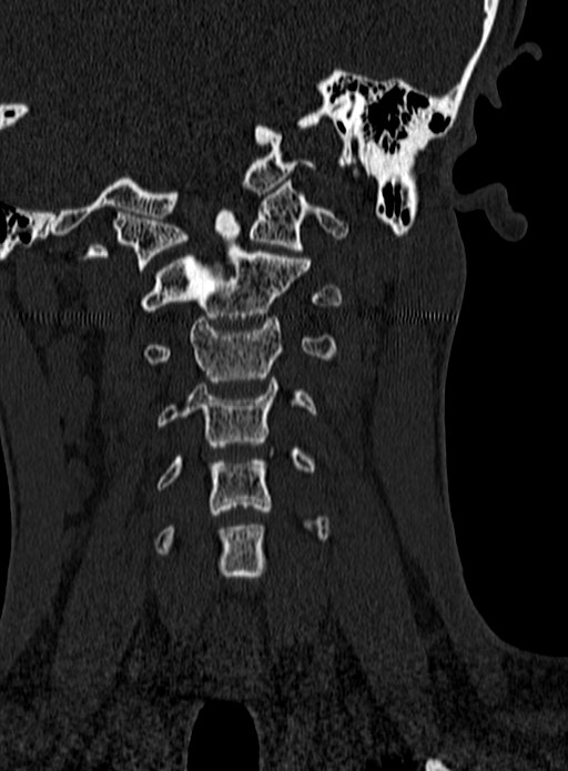 Atlantoaxial subluxation (Radiopaedia 44681-48450 Coronal bone window 40).jpg