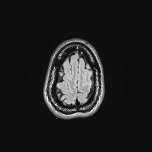 Atretic encephalocoele with inferior vermis hypoplasia (Radiopaedia 30443-31108 Axial 139).jpg