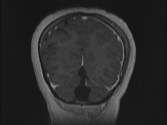 Atypical meningioma (Radiopaedia 62985-71406 Coronal T1 C+ 107).jpg