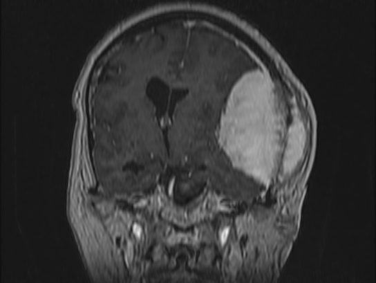 Atypical meningioma (Radiopaedia 62985-71406 Coronal T1 C+ 54).jpg